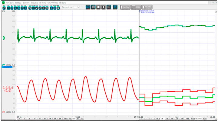 心電図と血圧の生波形とトレンド表示画面